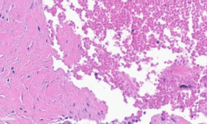 biomarker analysis wound healing